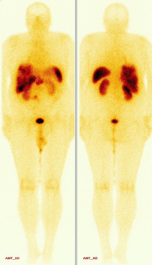 Obr. 1. Celotlov scintigrafie s 111In-pentetreotidem