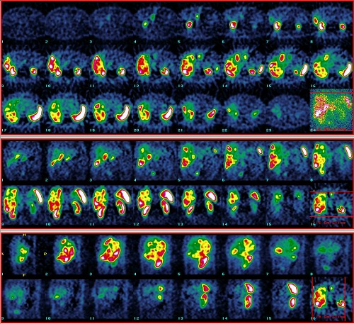 Obr. 3. SPECT dutiny bin