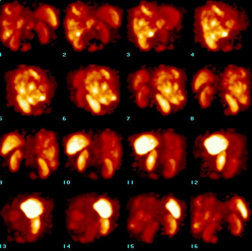 Obr. 10. SPECT dutiny bin, 3D rekonstrukce