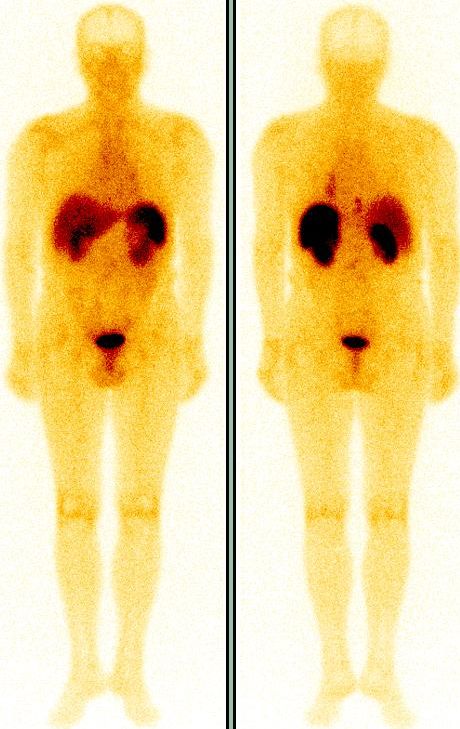 Obr. 1. Celotlov scintigrafie s 111In-pentetreotidem