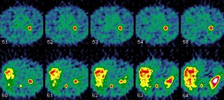 Obr. 7. SPECT dutiny hrudn, transverzln ezy