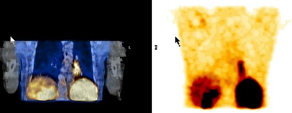 Obr. 9. SPECT/CT dutiny hrudn, koronrn ez