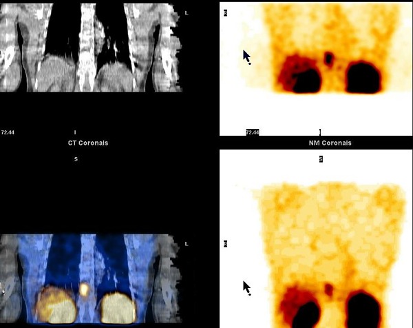 Obr. 10. SPECT/CT dutiny hrudn, koronrn ezy