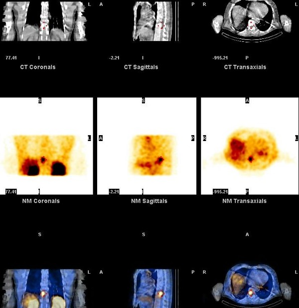 Obr. 11. SPECT/CT dutiny hrudn