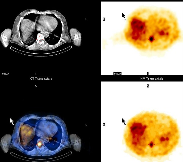 Obr. 13. SPECT/CT dutiny hrudn, transversln ezy