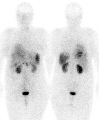 Obr..1: Celotlov scintigrafie v pedn a zadn projekci 4 hod. po aplikaci OctreoScanu