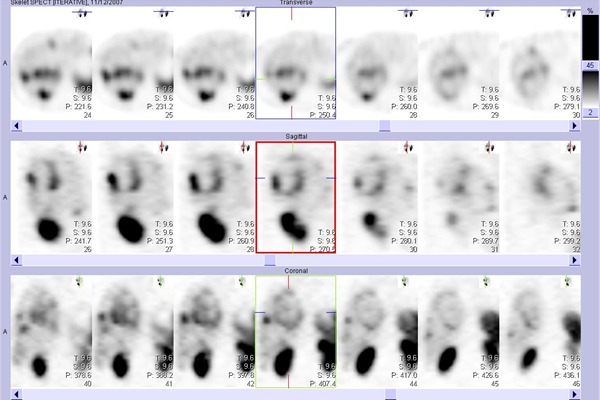 Obr.3: SPECT bicha a doln sti hrudnku 24 hod. po aplikaci OctreoScanu