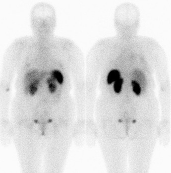 Obr..1: Celotlov scintigrafie v pedn a zadn projekci 4 hod. po aplikaci OctreoScanu