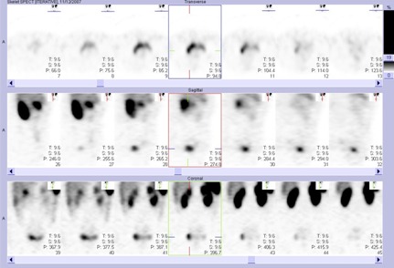 Obr.č.3: Tomografická scintigrafie břicha a pánve 24 hod. po aplikaci OctreoScanu se zaměřením na oblast močového měchýře