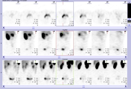 Obr..3: Tomografick scintigrafie bicha a pnve 24 hod. po aplikaci OctreoScanu se zamenm na oblast moovho mche