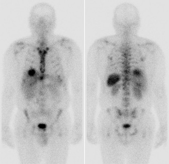 Obr. . 1: Celotlov scintigrafie v pedn a zadn projekci 4 hod. po aplikaci OctreoScanu