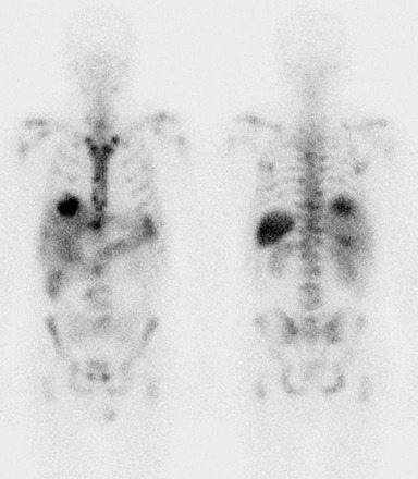 Obr. . 2: Celotlov scintigrafie v pedn a zadn projekci 24 hod. po aplikaci OctreoScanu