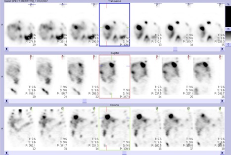 Obr. . 3: Tomografick scintigrafie bicha a pnve 24 hod. po aplikaci OctreoScanu