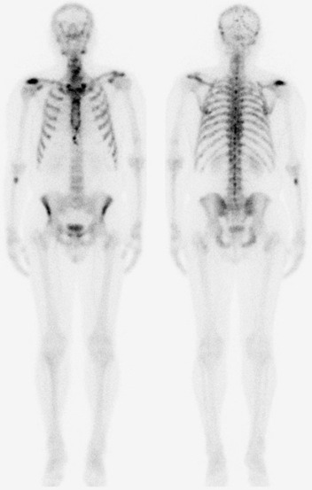 Obr. . 1: Celotlov scintigrafie skeletu v pedn a zadn projekci