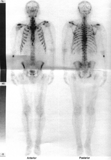 Obr. . 2: Celotlov scintigrafie skeletu v pedn a zadn projekci