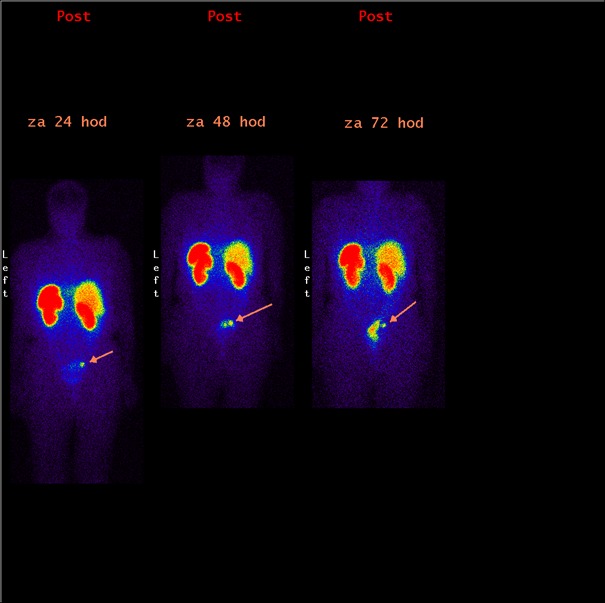 Obr. 1: Celotlov scintigrafie pomoc 111In-OctreoScan