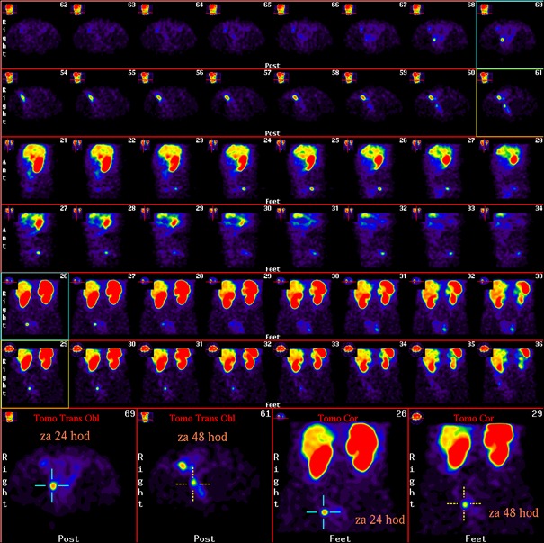 Obr. 2: Scintigrafie 111In-OctreoScan metodou SPECT