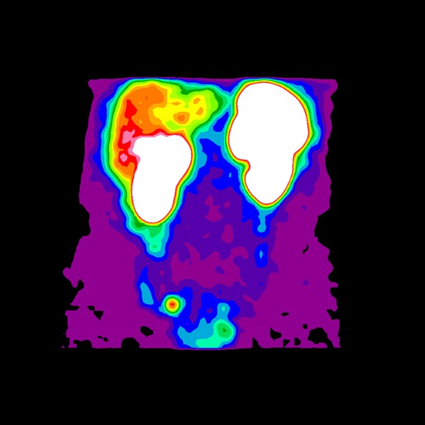 Obr. 4: Zobrazení metodou maximum pixel raytrace s fyziologickou akumulací v ledvinách, slezině a játrech