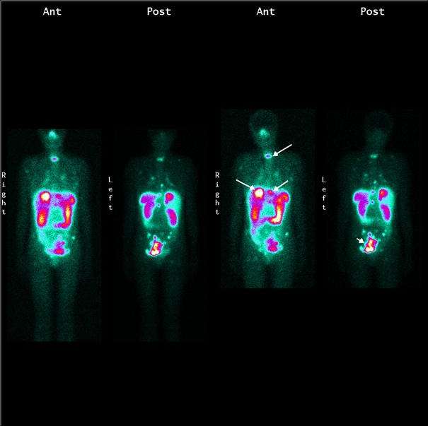 Obr.1.: Scintigrafie pomoc 111In-OctreoScan metodou whole body za 24 a 48 hodin po aplikaci radiofarmaka