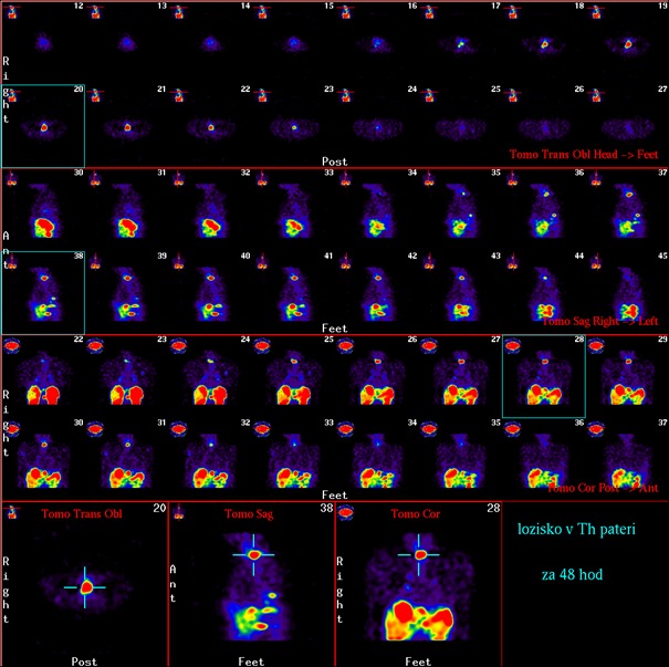 Obr.2.: Scintigrafie pomoc 111In-OctreoScan metodou SPECT