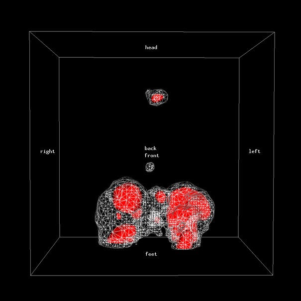 Obr.4.: Scintigrafie pomoc 111In-OctreoScan metodou SPECT