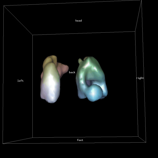 Obr.5.: 3D zobrazení plicní perfúze se zřetelným ložiskovým výpadkem vpravo.