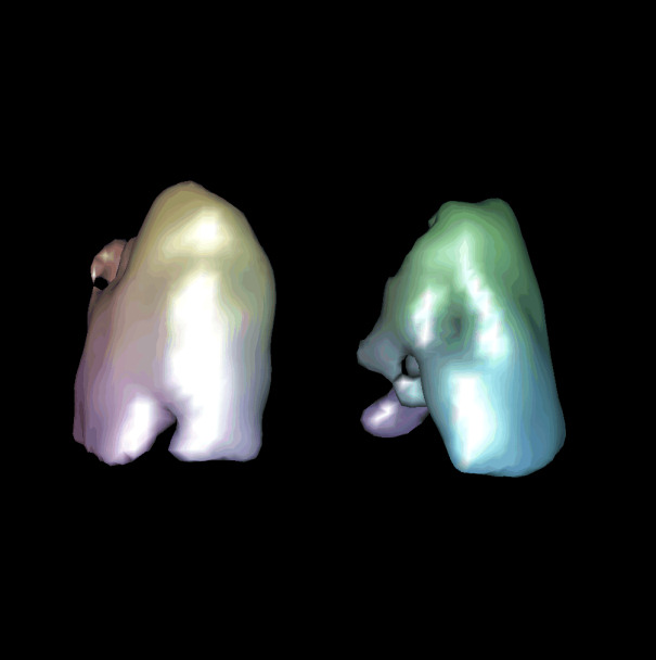 Obr.5.: 3D zobrazení perfúze plicní-perfúzní výpadek laterobasálně vlevo.