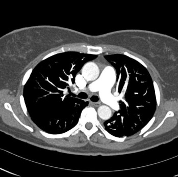Obr. č. 3: CT plicní angiografie