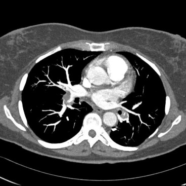 Obr. č. 5: CT plicní angiografie