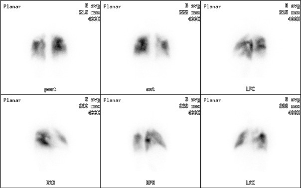 Obr. 3.: Perfúzní plicní scintigrafie metodou planární v 6 projekcích - AP, PA, LPO, LAO, RPO a RAO s totálními výpadky perfúze plicní bilaterálně (dvouhlavá SPECT kamera).