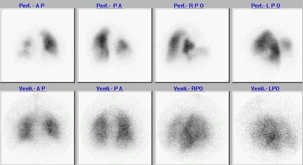 Obr. . 1: Perfuzn-ventilan scintigrafie plic