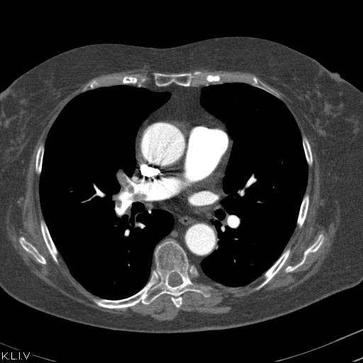 Obr. č. 3: CT plicní angiografie