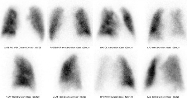 Obr. č. 1: Perfuzní scintigrafie plic na dvoudetektorové tomografické kameře