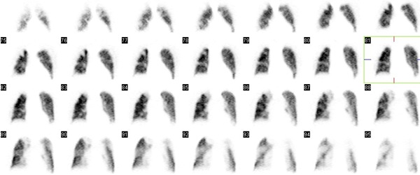 Obr. č. 3: Perfuzní tomografická scintigrafie plic na dvoudetektorové tomografické kameře, vybrány koronální řezy