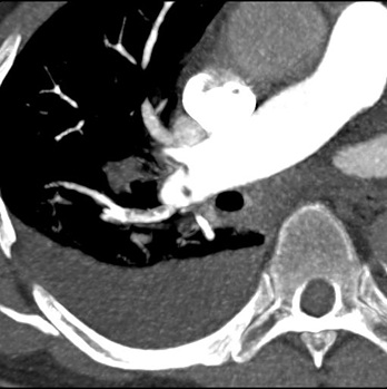 Obr. č. 4: CT plicní angiografie