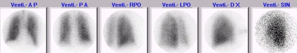 Obr. . 6: Kontroln ventilan scintigrafie plic na planrn kamee