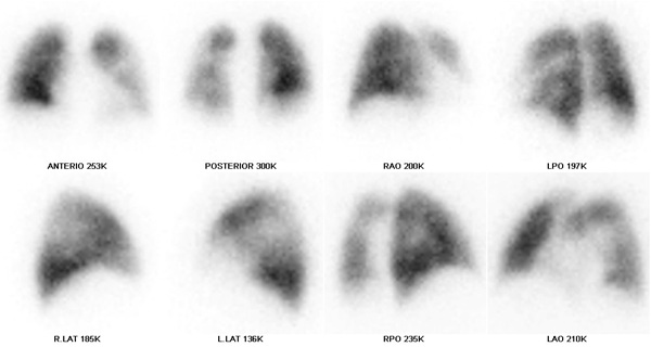 Obr. č. 3: Perfuzní scintigrafie plic na dvoudetektorové tomografické kameře
