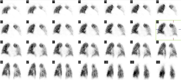 Obr. č. 4: Perfuzní tomografická scintigrafie plic na dvoudetektorové tomografické kameře, vybrány koronální řezy