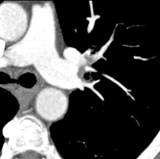 Obr. č. 6: CT plicní angiografie
