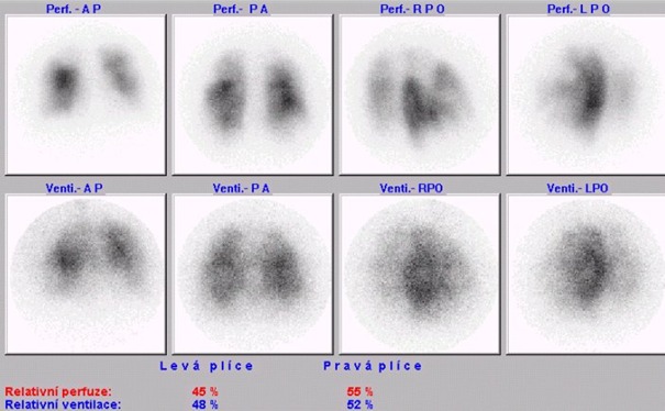 Obr. . 1: Kombinovan perfuzn a ventilan scintigrafie plic na planrn kamee