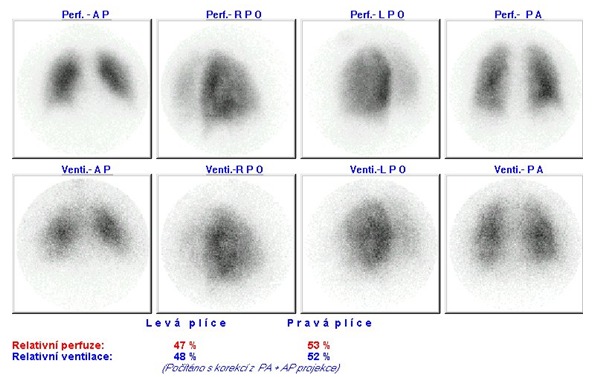 Obr. . 2: Kontroln kombinovan perfuzn a ventilan scintigrafie plic na planrn kamee