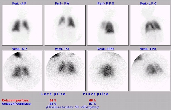 Obr. . 1: Kombinovan perfuzn a ventilan scintigrafie plic na planrn kamee