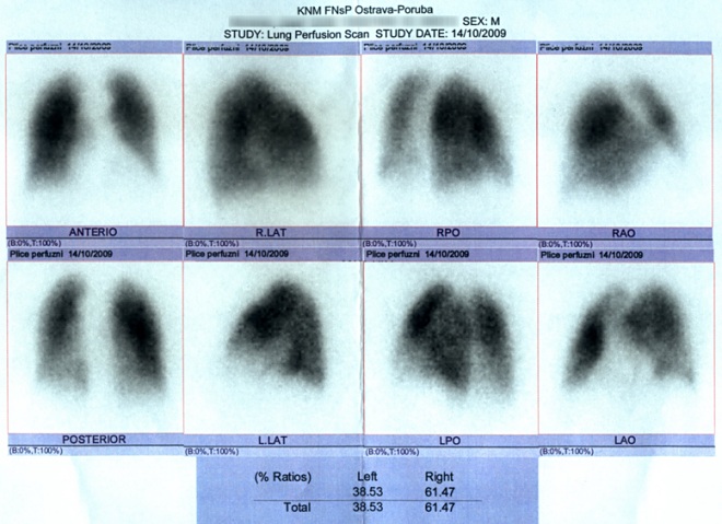 Obr. . 2: Perfuzn scintigrafie plic proveden na dvoudetektorov tomografick scintilan kamee