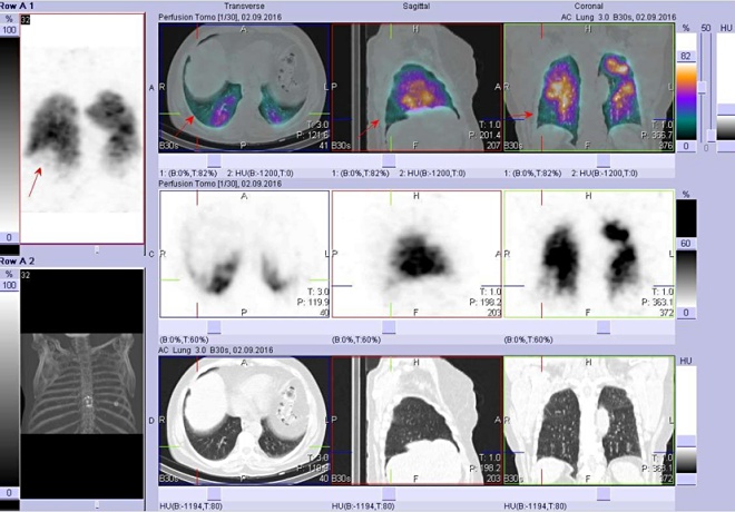 Obr. . 2: Perfuzn scintigrafie plic - hybridn zobrazen SPECT/CT, fze obraz
