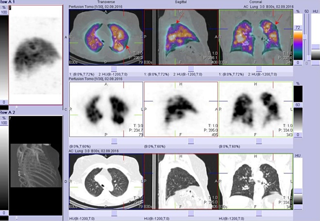 Obr. . 4: Perfuzn scintigrafie plic - hybridn zobrazen SPECT/CT, fze obraz