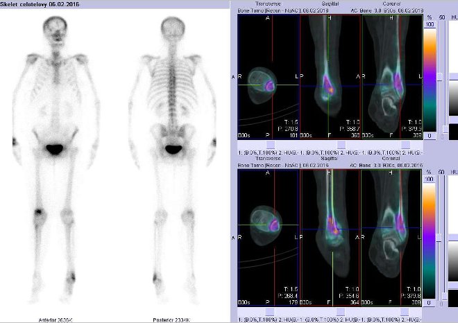 Obr. . 3: Celotlov scintigrafie vpedn a zadn projekci a fze obraz SPECT a CT. Vpravo fze obraz SPECT a CT - zameno na distln st lev fibuly - ezy transverzln, sagitln a koronln.