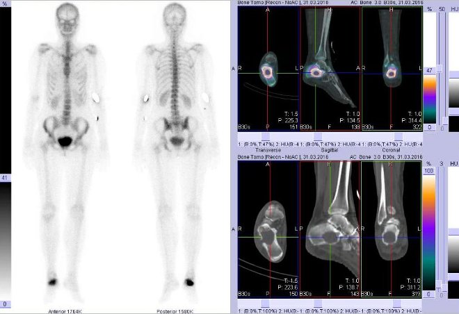 Obr..1: Celotlov scintigrafie v pedn a zadn projekci a fze obraz SPECT a CT. Vpravo fze obraz SPECT a CT - zameno na loisko v prav patn kosti. ezy transverzln, sagitln a koronln.