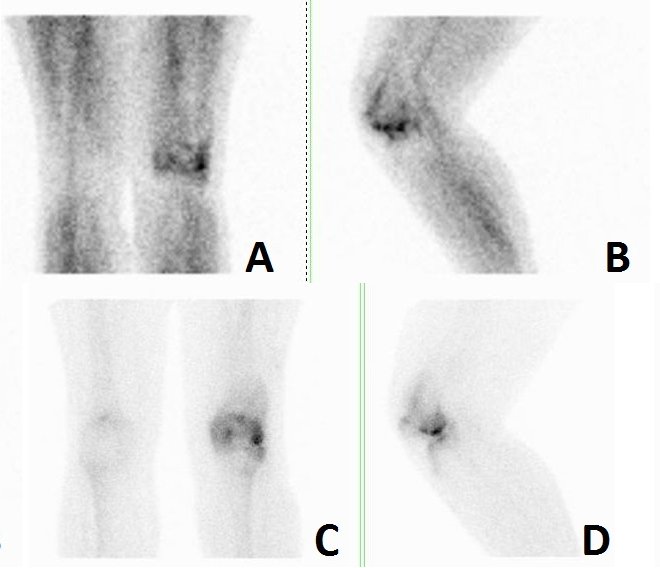 Obr.1.: Obraz zvenho krevnho poolu v lemu kolem distlnho konce levho femuru zejmna laterln v pedn a lev bon laterln projekci (A, B) a statick scany se zvenou depozic RF v laterlnm kondylu levho femuru v tch projekcch (C, D). Nlez odpovd pokozen kloubn plochy femuru s obrazem leh synovialitidy.