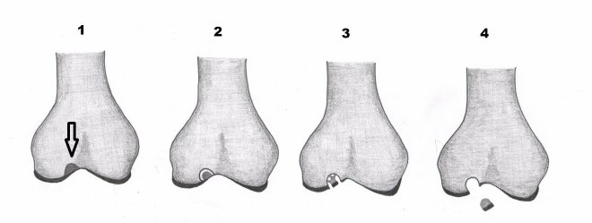 Obr.3.: Stdia disekujc osteochondritidy 1-4. 1 - vyznaen stabiln lze v kosti,2 - naznaen odlouen fragmentu v kosti, 3 - fragmentace chrupavky, 4 - dislokace fragmentu s obrazem osteochondrlnho defektu na LDCT.