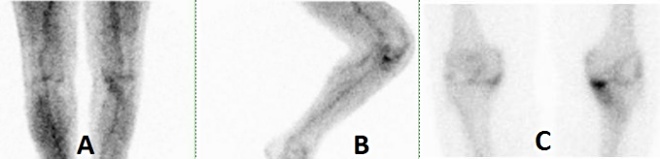 Obr.1.: Obraz zvenho krevnho poolu fokln v medilnm kondylu femuru a dle i v lemu kolem distlnho konce levho femuru v pedn a lev bon laterln projekci (A, B) a statick scan se zvenou depozic RF v medilnm kondylu levho femuru v pedn projekci (z WB scanu - C). Nlez odpovd pokozen kloubn plochy femuru s obrazem leh synovialitidy.